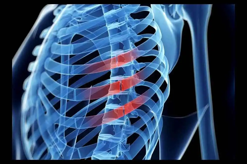 Long-term Effects of Broken Ribs