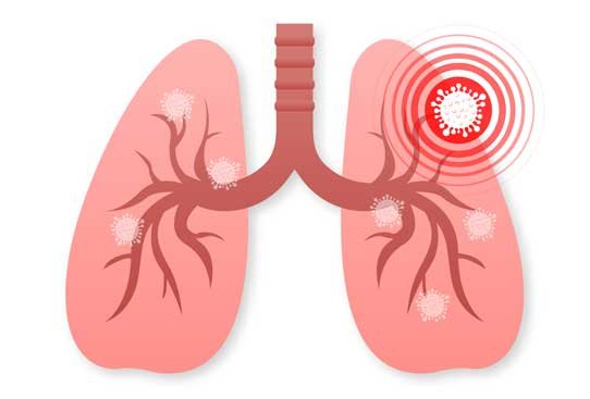 Severe chest infection Treatment