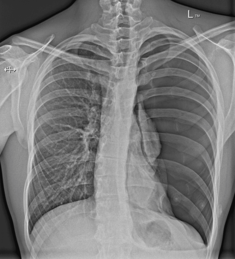 Spontaneous Pneumothorax