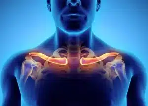 Thoracic outlet syndrome