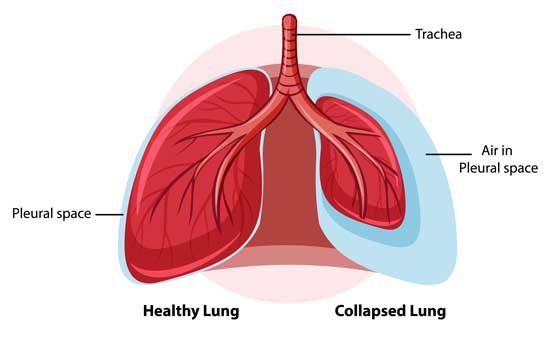 Collapsed Lung Treatment | Thoracic Surgeon | Mr. Marco Scarci