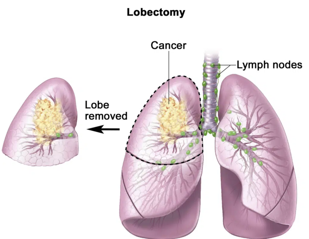 What are the most common thoracic surgery procedures?