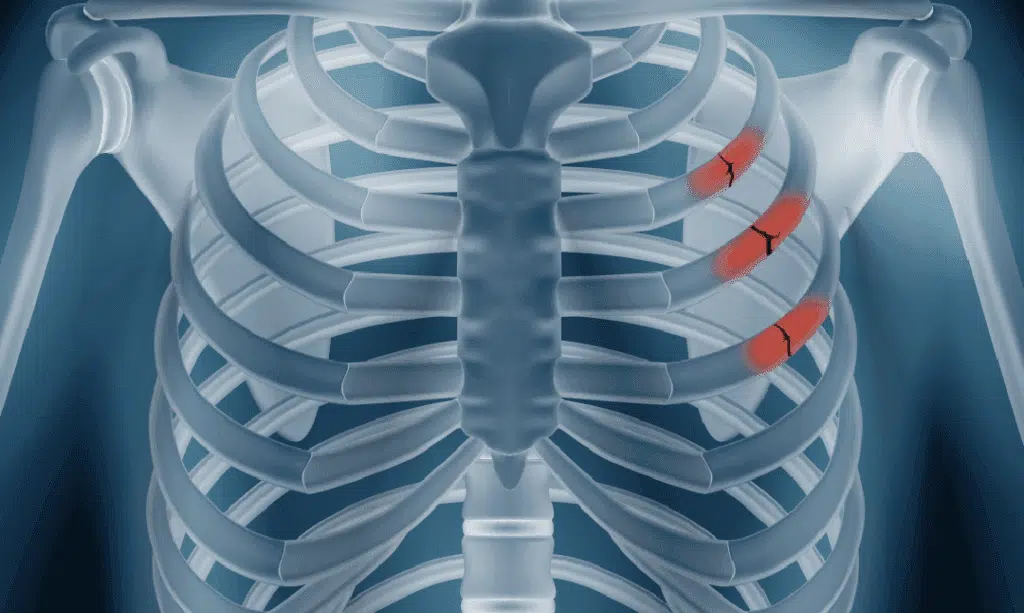 Broken Rib Symptoms: A Comprehensive Guide to Recognition and Recovery