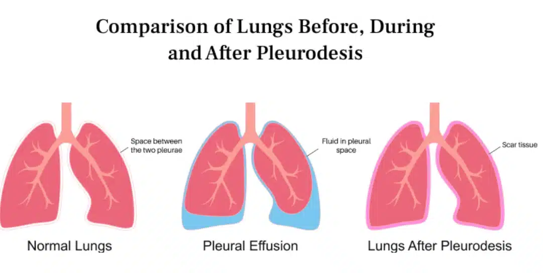 pleurodesis