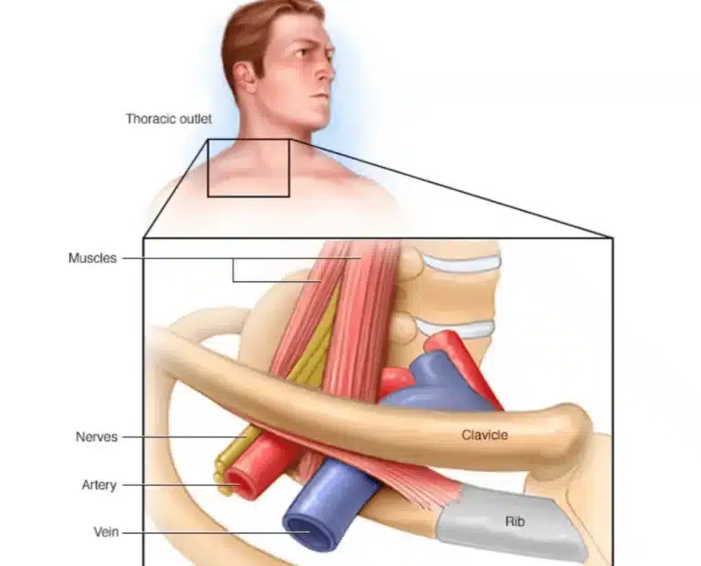 Thoracic Outlet Syndrome