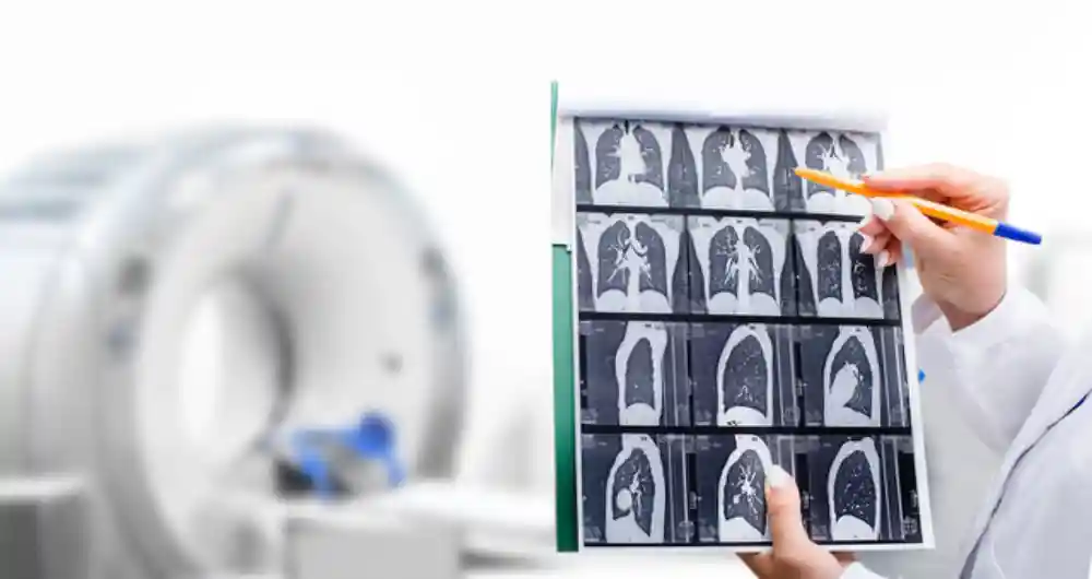 Understanding Lung Cancer Screening: Pros, Cons, and What to Expect