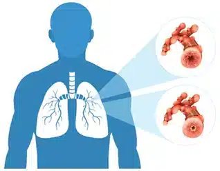 Understanding Mesothelioma Cancer: Staging, Treatment, and Prognosis 1 2413148 13556.jpg