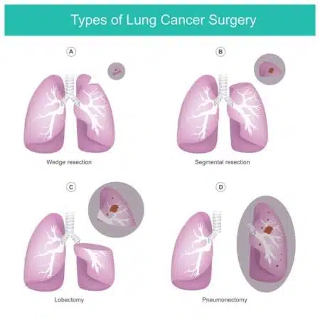 Lung Cancer Surgery Types of lung cancer surgery