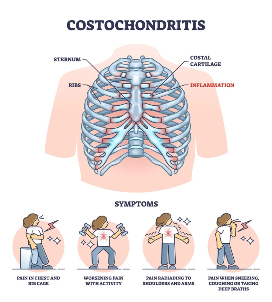 Costochondritis infographics