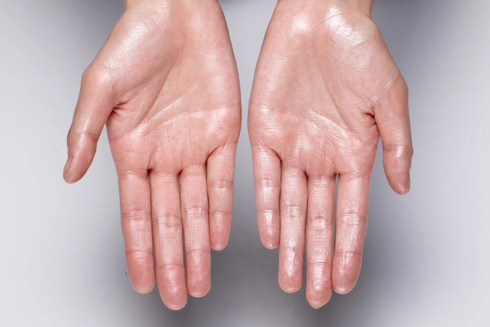 Complete Guide to Hyperhidrosis Treatment: From Conservative Options to ETS Surgery 1 Excessive sweating in the palms
