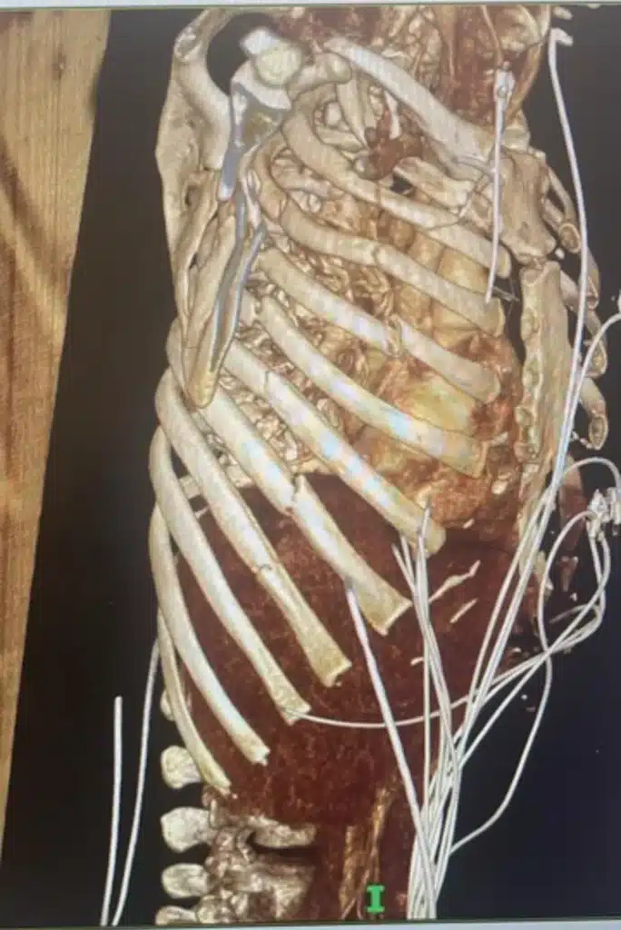 Fractured Ribs