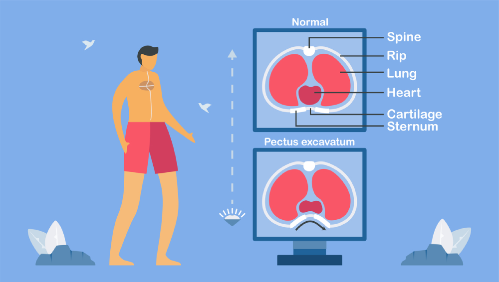 Pectus Excavatum