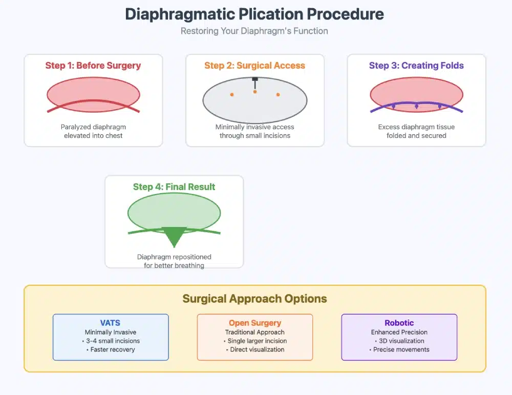 diaphragmatic plication schematic
