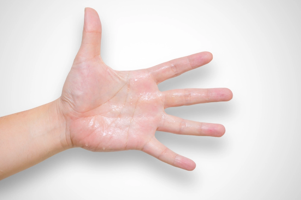 hyperhidrosis