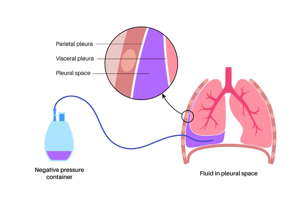 pleural drainage