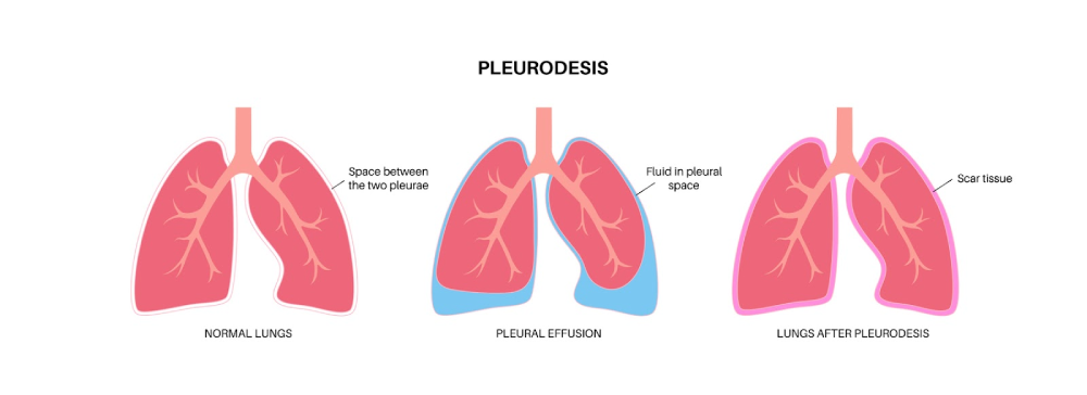 pleurodesis infographics