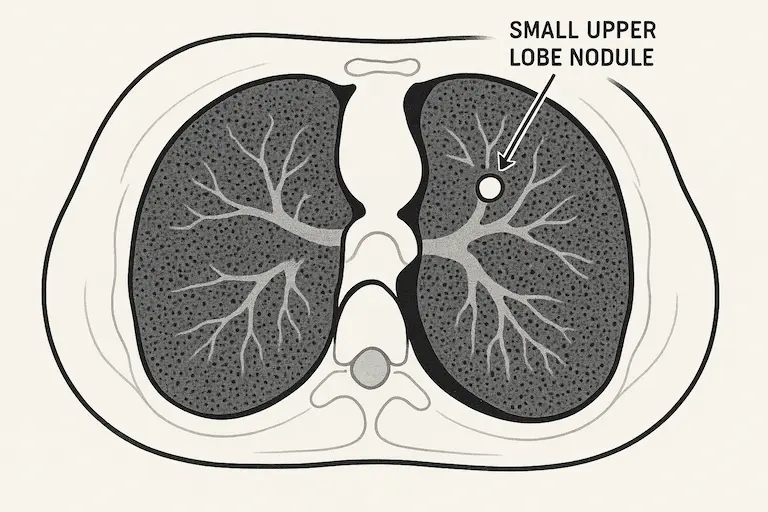 CT scan illustration showing a small nodule in the right upper lobe of the lung