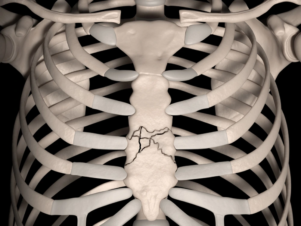 Sternal Fractures Anatomy