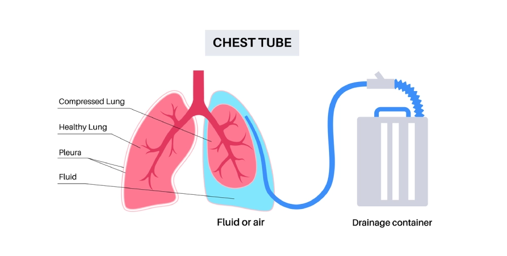 chest tube