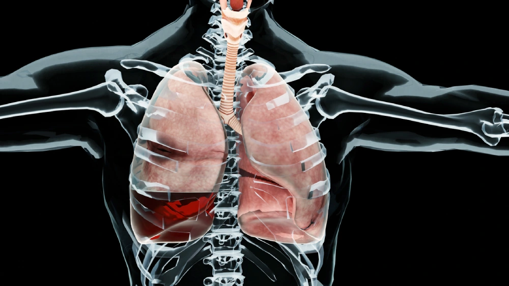 empyema condition