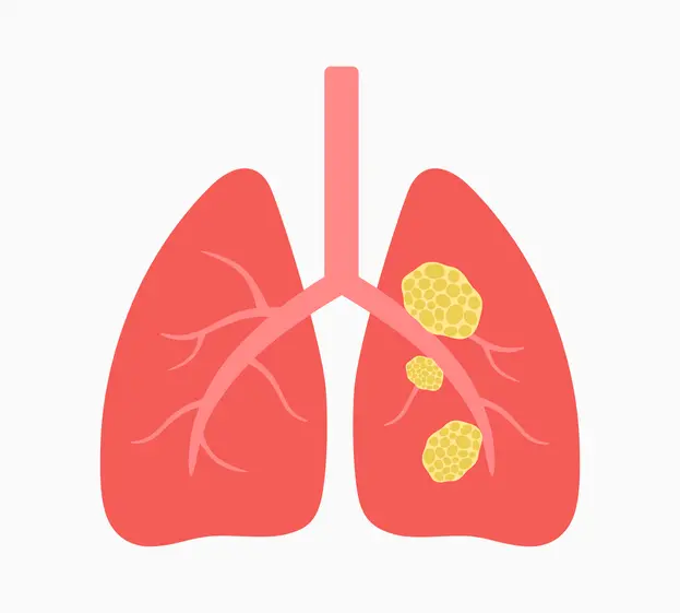 Illustration of lungs with visible tumors.
