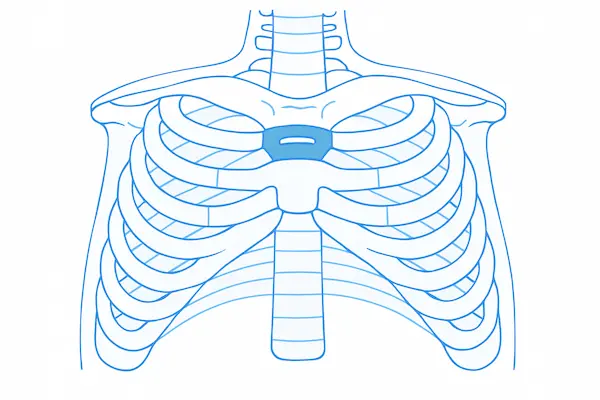 Chest Wall Deformities 3 Medical illustration of the ribcage showing chest wall deformity, useful for comparison with pectus excavatum anatomy.
