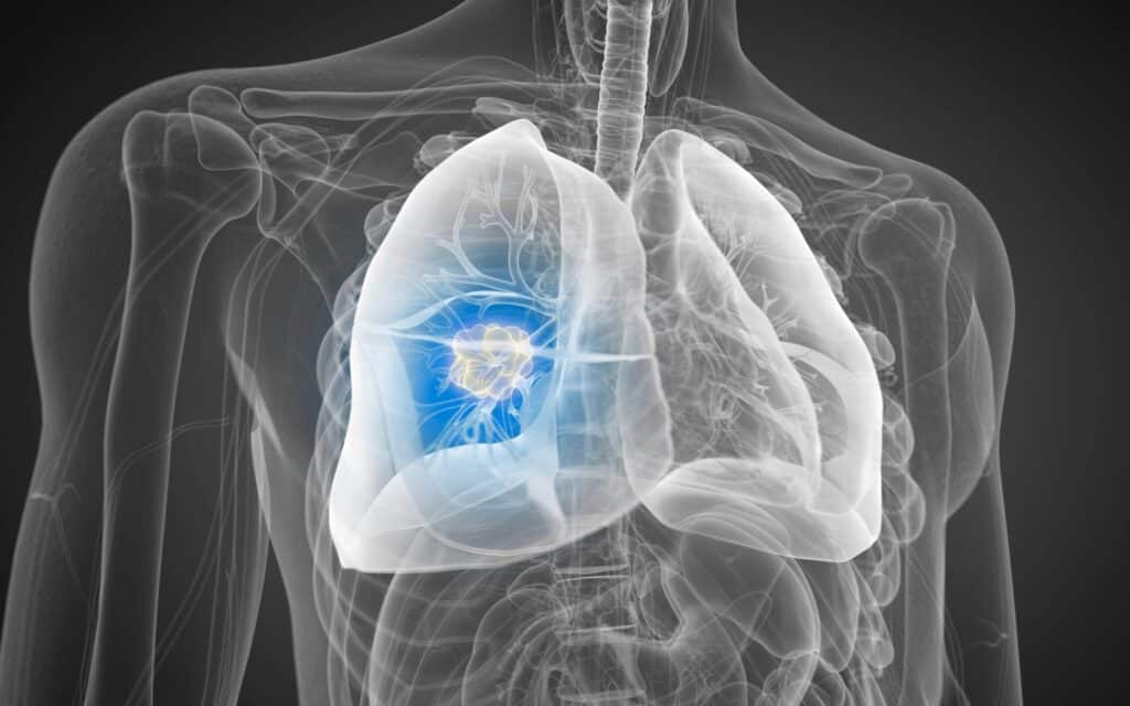 Lung Cancer treatment UK