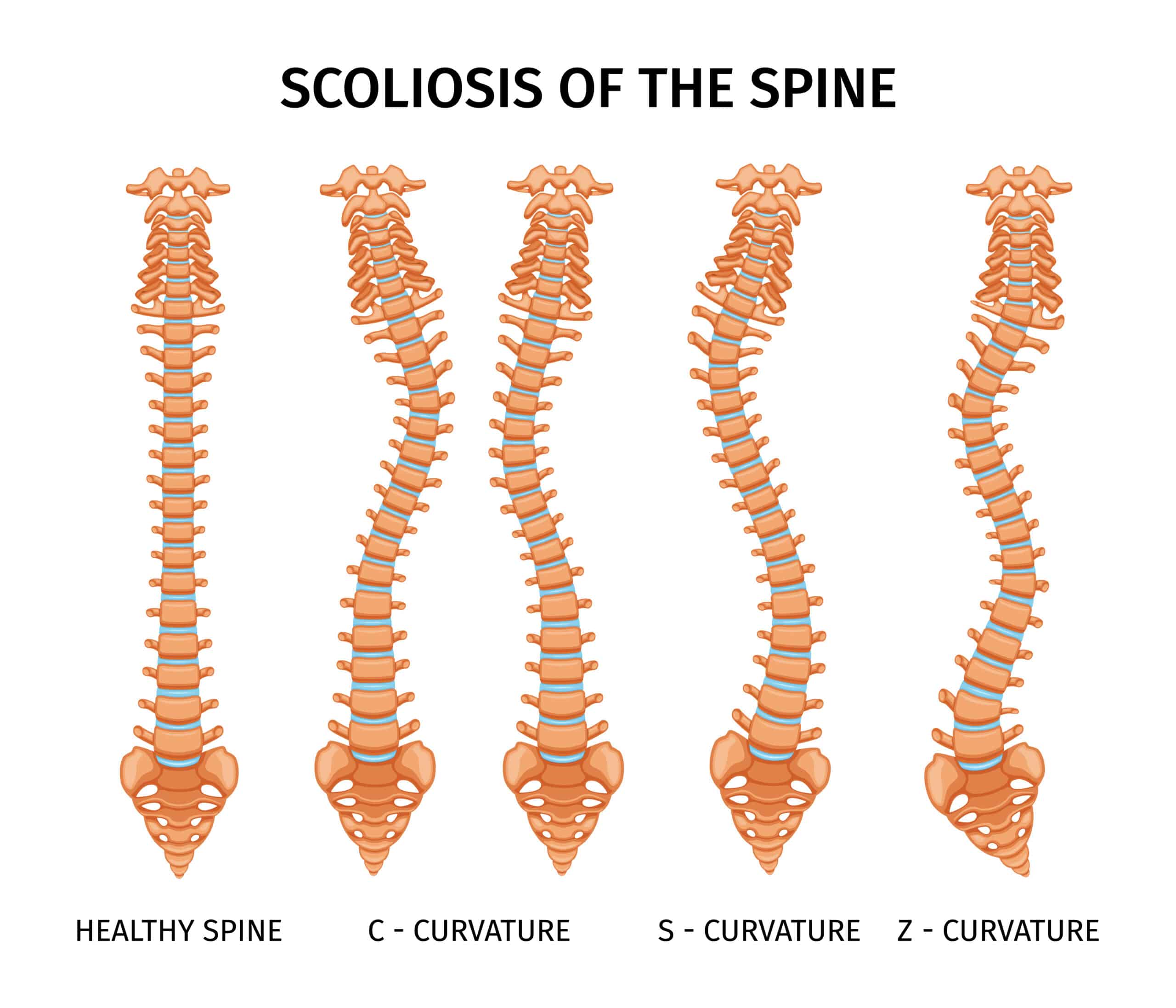 Slipping Rib Scoliosis: Can Scoliosis Cause Slipping Rib Syndrome - Expert Thoracic Surgery Perspective 2 Types of scoliosis, spine anatomy