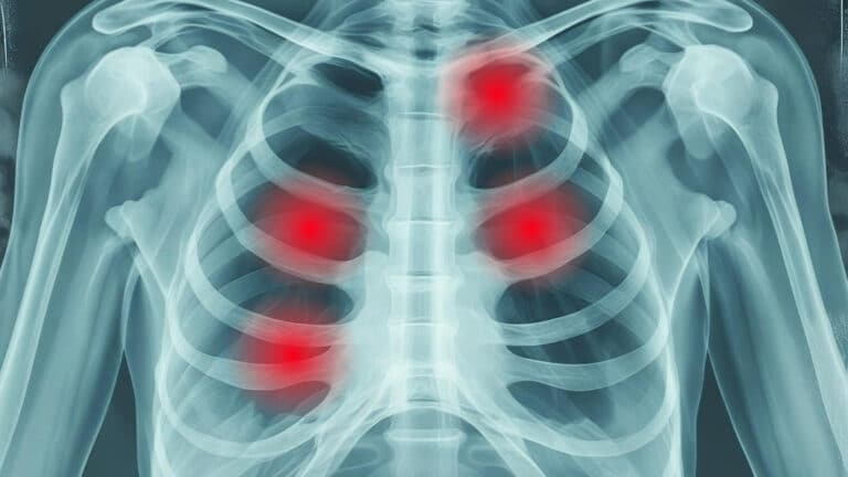 Intercostal Neuralgia: Causes, Symptoms and Treatment Options