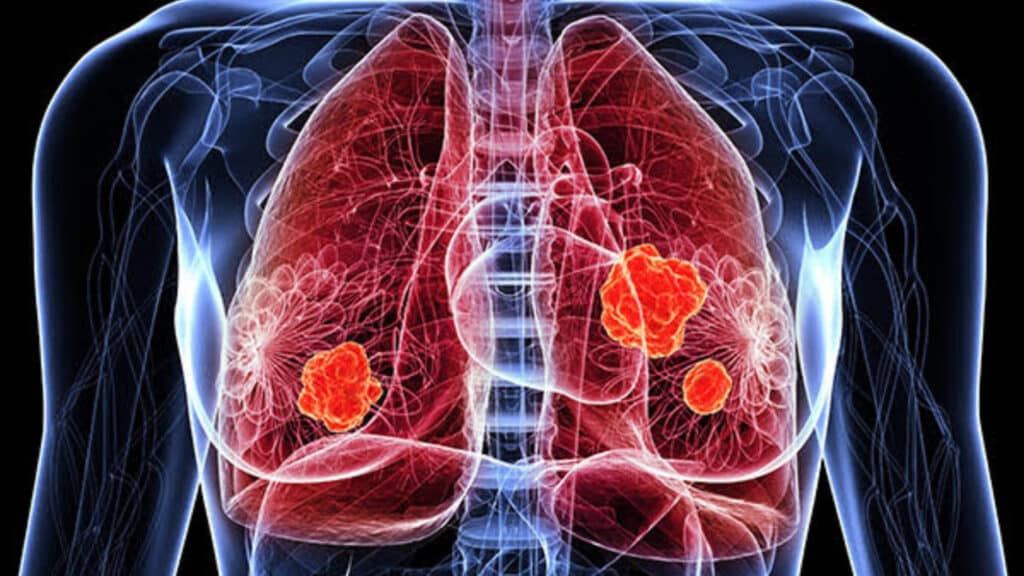 Lung Cancer