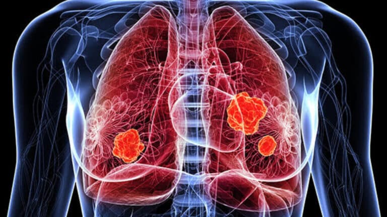Can Lung Cancer Be Cured Without Surgery?