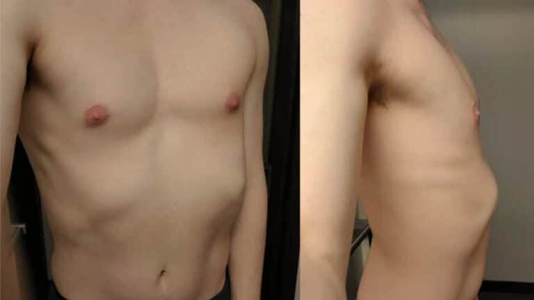 Rib Flaring Treatment: Causes, Prevention and When Surgery Is Needed