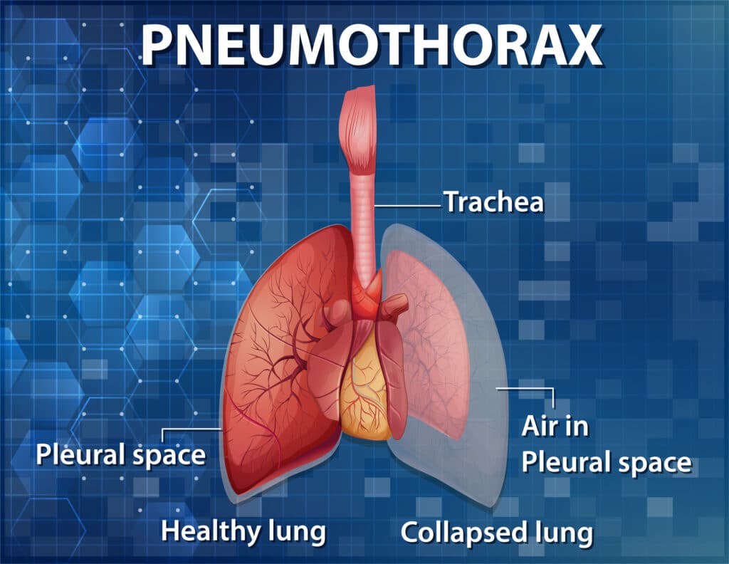 When Does a Collapsed Lung Need Surgery (and When Does It Not)? 1 Pneumothorax Diagram