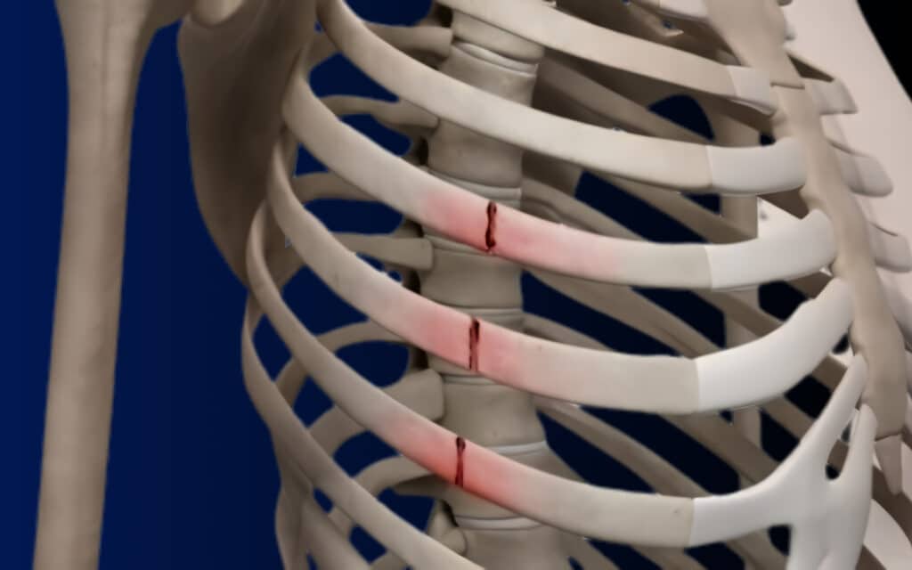 Rib Fracture Healing Time: Can Fractured Ribs Heal on Their Own? 1 Rib Fracture Model