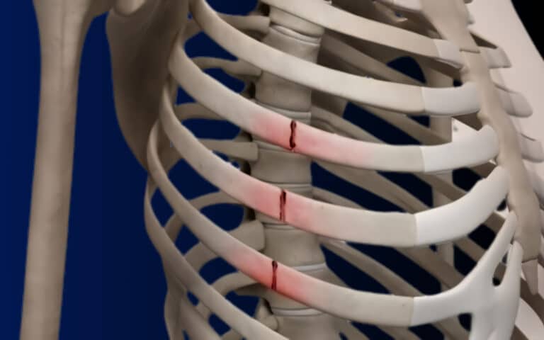 Rib Fracture Healing Time: Can Fractured Ribs Heal on Their Own?