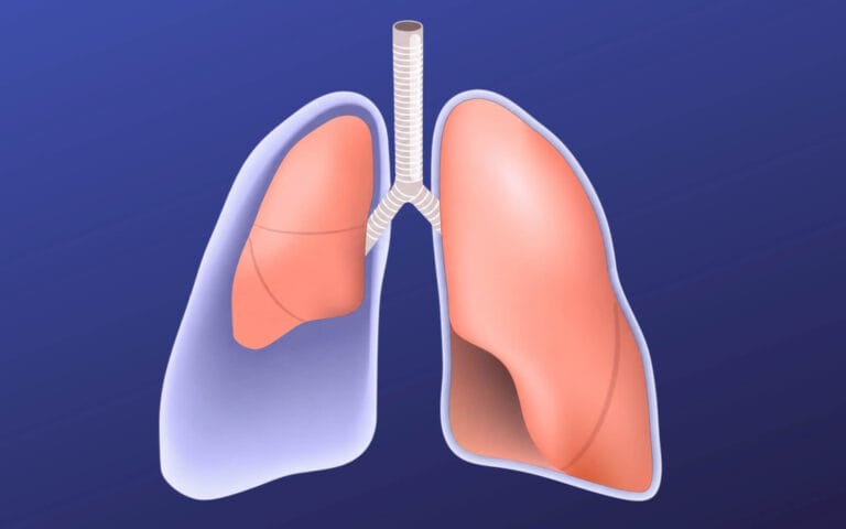 A Collapsed Lung: Where Does the Pain Occur and What Does It Feel Like?