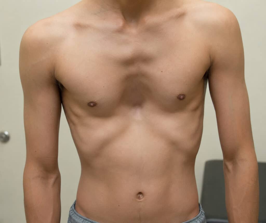 Chest Wall Deformities: Types, Causes, Symptoms and Treatment Options