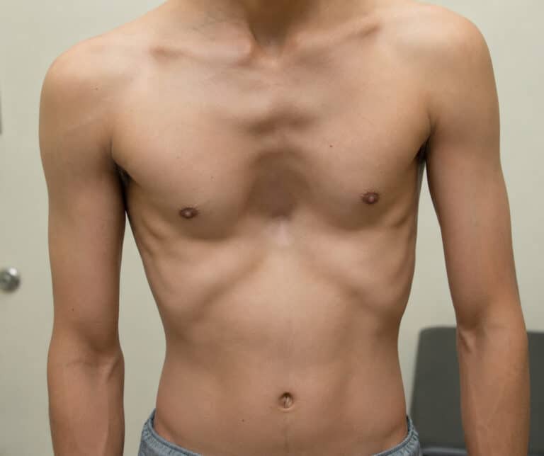 Chest Wall Deformities: Types, Causes, Symptoms and Treatment Options