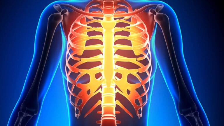 The Difference Between Costochondritis and Rib Fracture