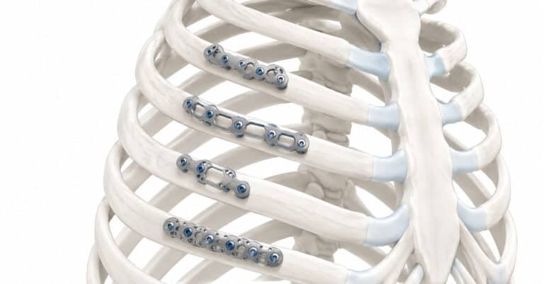 How Long Does a Titanium Rib Plate Stay in Your Body?