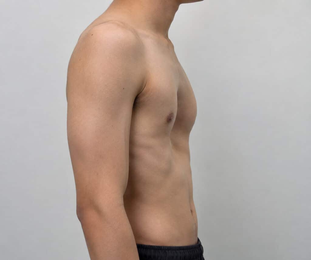 Funnel Chest Surgery (Pectus Excavatum): When It's Recommended and What to Expect
