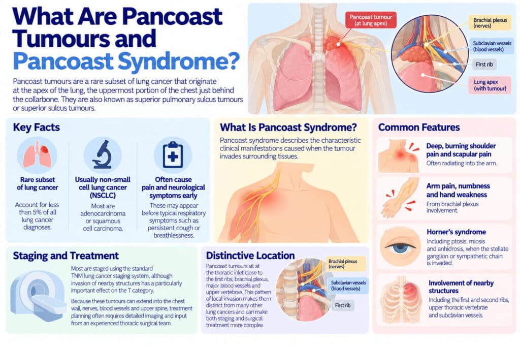 What Are Pancoast Tumours and Pancoast Syndrome?