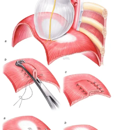 Diaphragm surgery