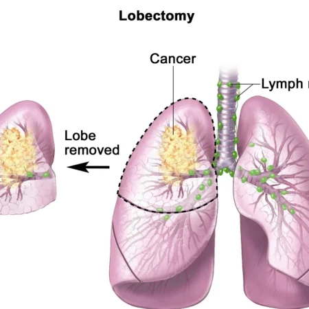 Lung Cancer Surgery