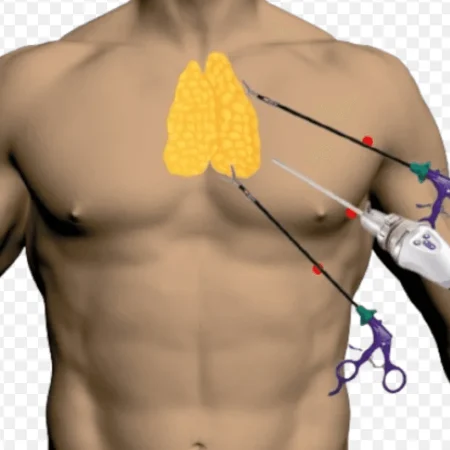 Thymoma Surgery