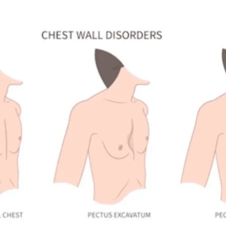 chest wall deformity