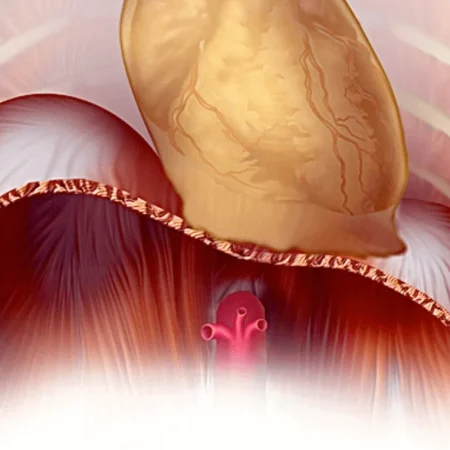 Diaphragmatic Paralysis