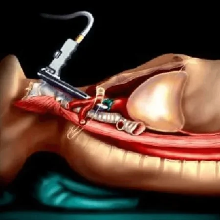 Mediastinal Lymph Nodes