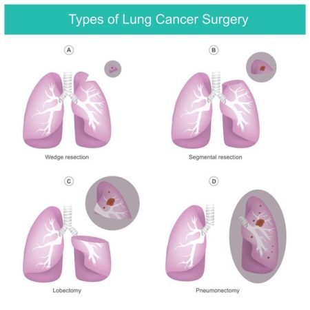 Lung Cancer Surgery